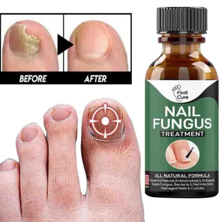 Effective Nail Repair & Fungus Treatment Serum (10ml)