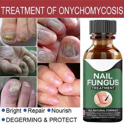 Effective Nail Repair & Fungus Treatment Serum (10ml)