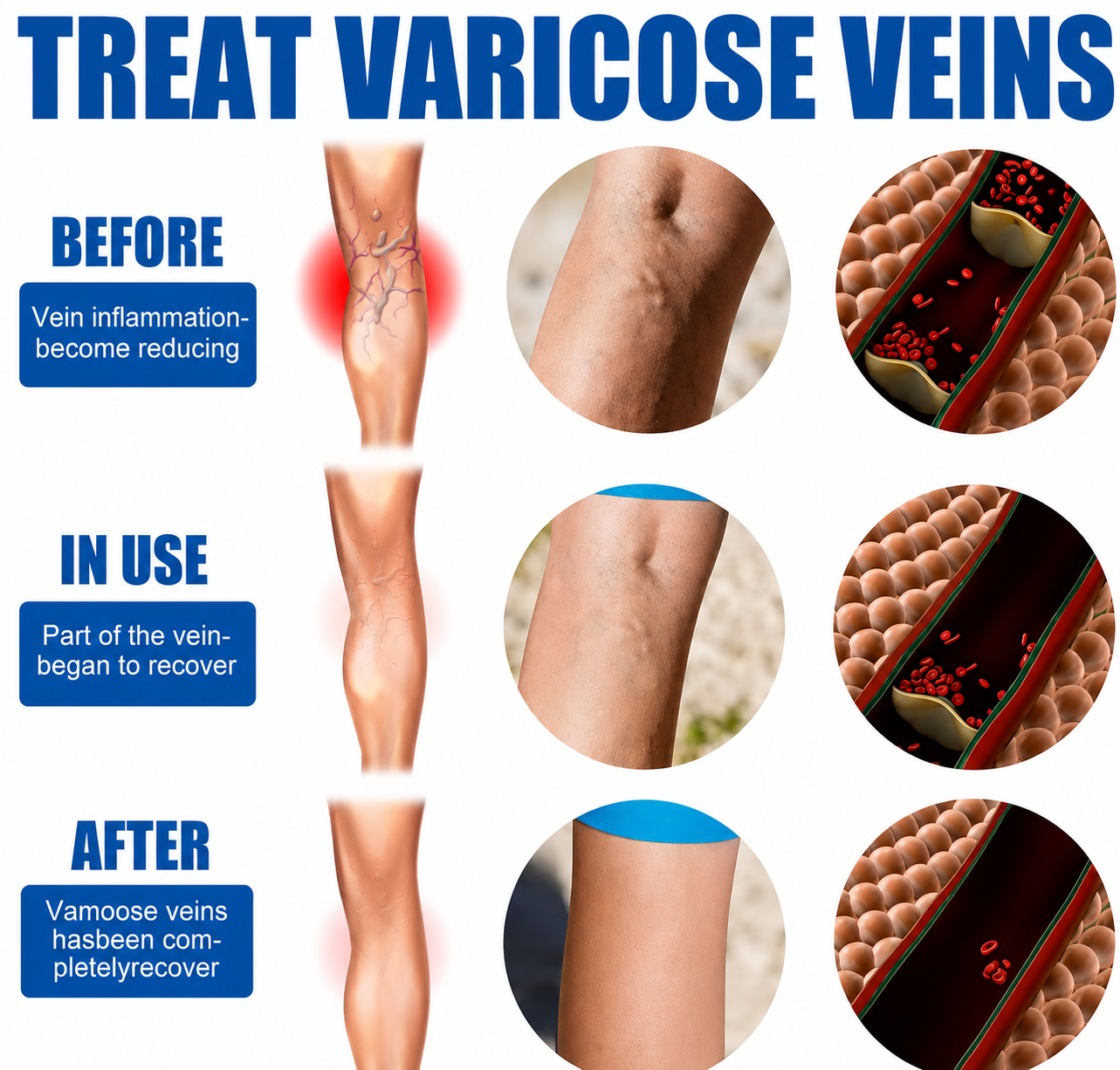 Varicose Veins Treatment Spray - Veins Relief Oil
