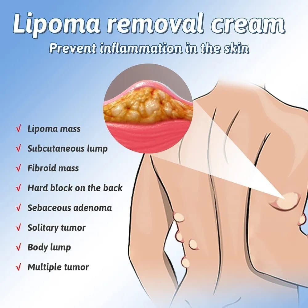 Lipoma Removal Cream for Fat Retention & Herbicide Action